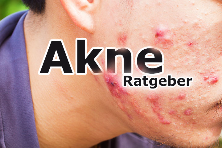 Akne Ratgeber