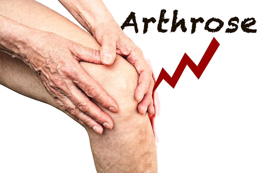 Arthrose