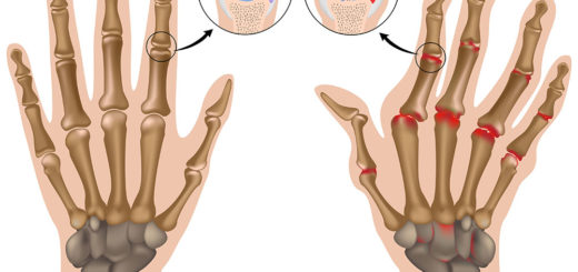 Rheumatoide Arthritis