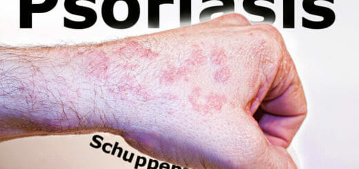 Was ist Psoriasis oder Schuppenflechte?