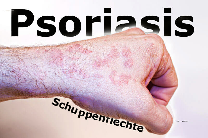 Was ist Psoriasis oder Schuppenflechte?